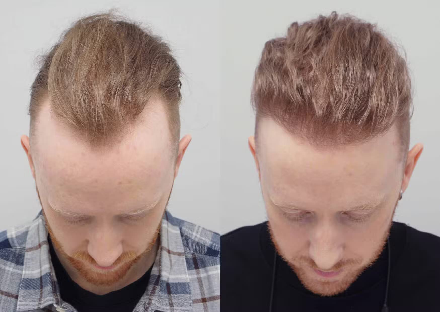 New York Hair Replacement with Precision Styling